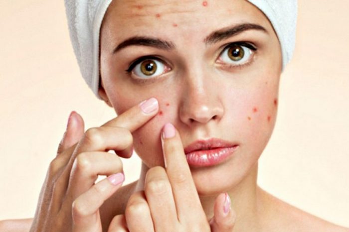 Yuzdeki-Sivilce-Nasil-Gecer