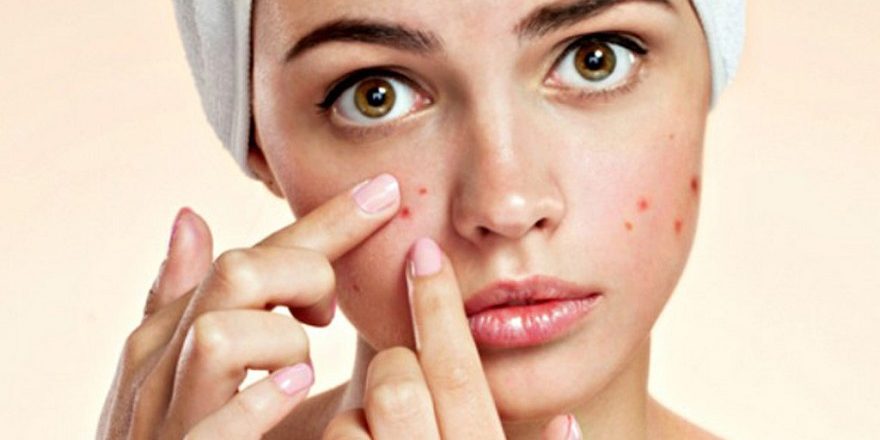 Yuzdeki-Sivilce-Nasil-Gecer Yuzdeki-Sivilce-Nasil-Gecer