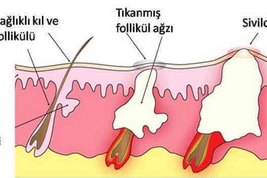sivilce akne nasıl oluşur
